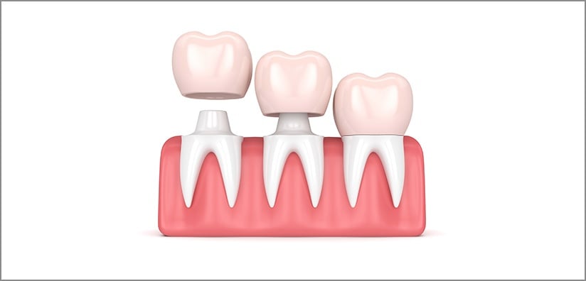 crown-cementation-tips-for-reducing-excess-cement